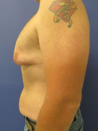 Gynecomastia Surgery (Male Breast Reduction Surgery): Case 16 - Before