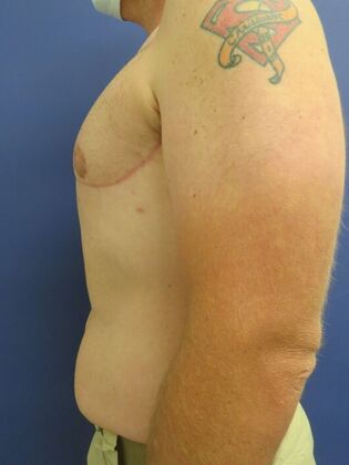 Gynecomastia Surgery (Male Breast Reduction Surgery): Case 16 - After