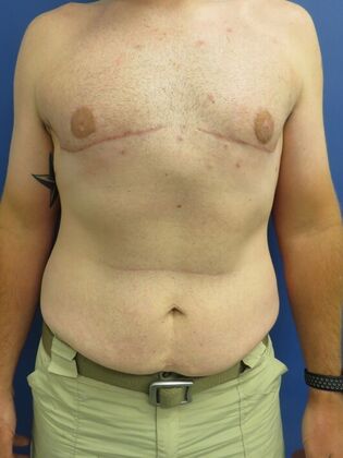 Gynecomastia Surgery (Male Breast Reduction Surgery) Case 16 - After