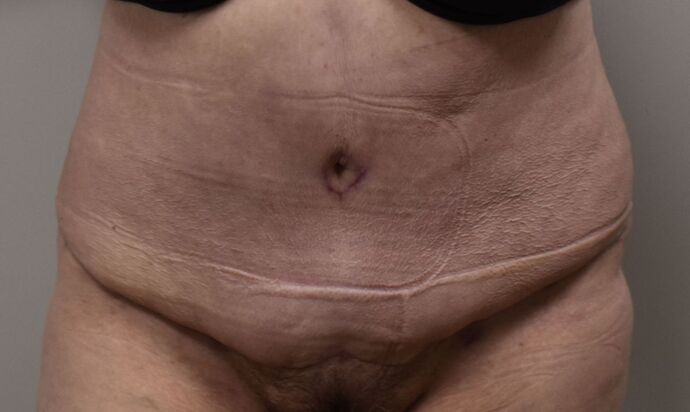 Tummy Tuck (Abdominoplasty): Case 483 - After