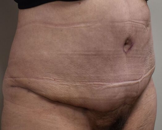 Tummy Tuck (Abdominoplasty): Case 483 - After
