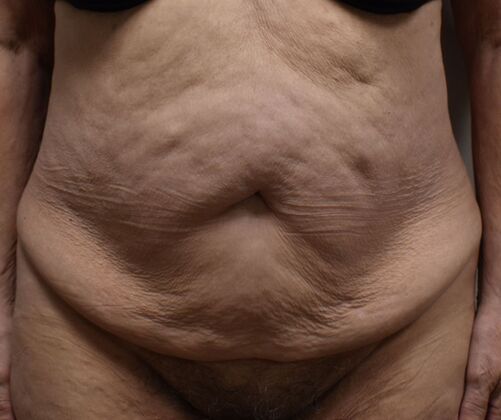 Tummy Tuck (Abdominoplasty): Case 483 - Before