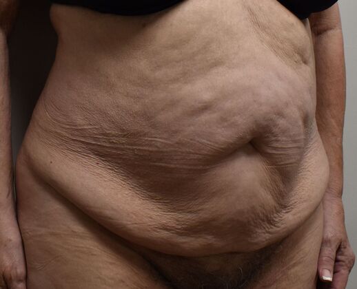Tummy Tuck (Abdominoplasty): Case 483 - Before