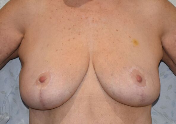 Breast Reduction Case 182 - After
