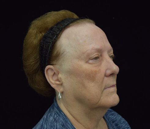 Laser Resurfacing Case 3 - Before