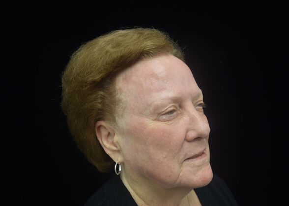 Laser Resurfacing Case 3 - After