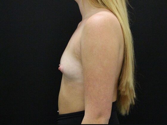 Breast Augmentation: Case 30 - Before
