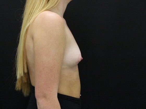 Breast Augmentation: Case 30 - Before