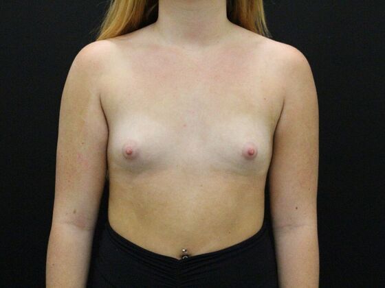 Breast Augmentation Case 30 - Before