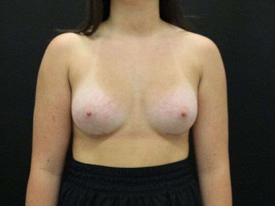 Breast Augmentation Case 30 - After