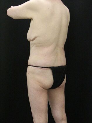 Tummy Tuck: Case 39 - After