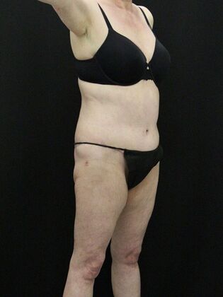 Tummy Tuck: Case 39 - After