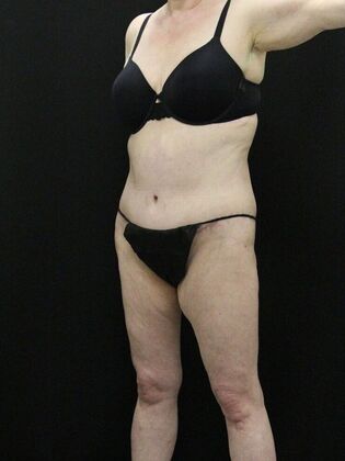 Tummy Tuck: Case 39 - After