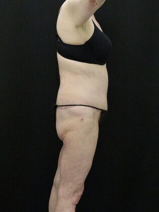 Tummy Tuck: Case 39 - After