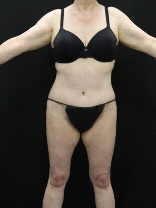 Tummy Tuck Case 39 - After