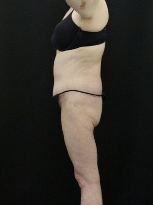 Tummy Tuck: Case 39 - After