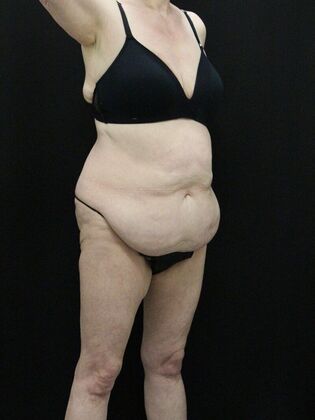 Tummy Tuck: Case 39 - Before