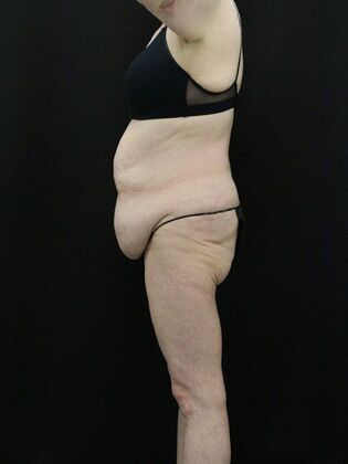 Tummy Tuck: Case 39 - Before