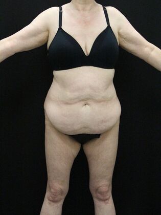 Tummy Tuck Case 39 - Before