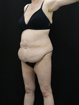 Tummy Tuck: Case 39 - Before