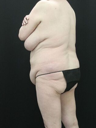 Tummy Tuck: Case 39 - Before