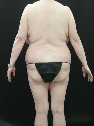 Tummy Tuck: Case 39 - Before