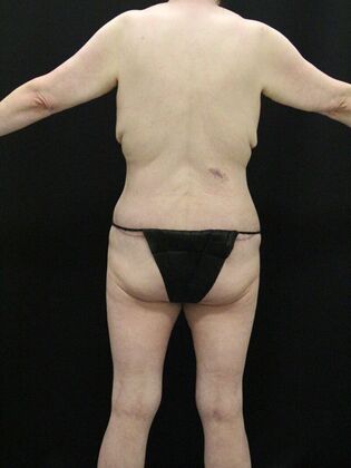 Tummy Tuck: Case 39 - After