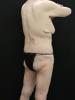 Tummy Tuck: Case 39 - After