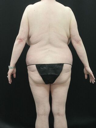 Body Lift Case 5 - Before