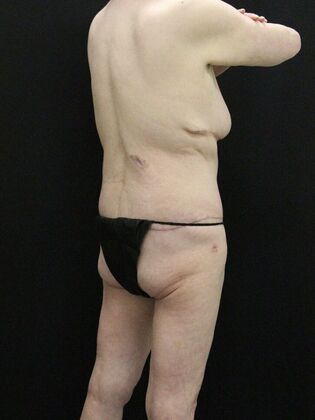 Body Lift: Case 5 - After