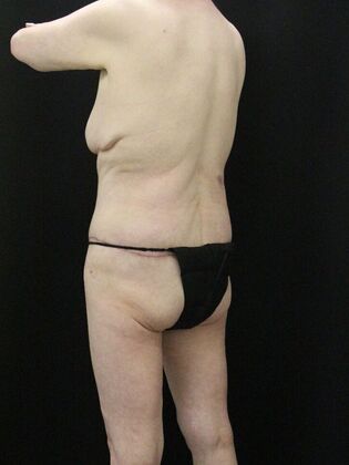 Body Lift: Case 5 - After