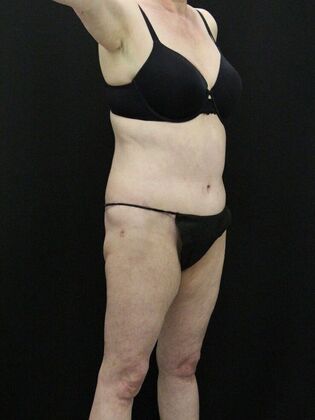 Body Lift: Case 5 - After