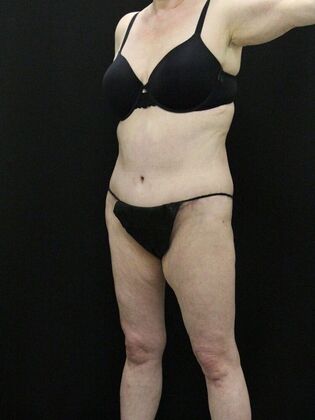 Body Lift: Case 5 - After