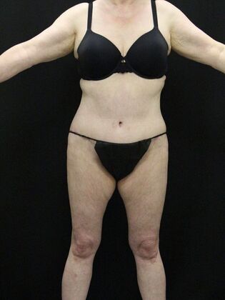 Body Lift: Case 5 - After