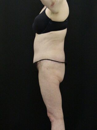 Body Lift: Case 5 - After