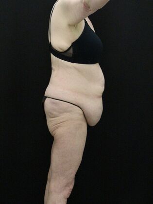 Body Lift: Case 5 - Before