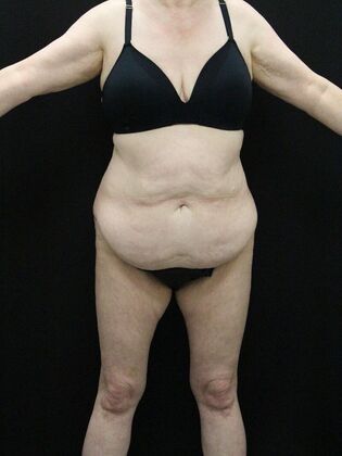 Body Lift: Case 5 - Before