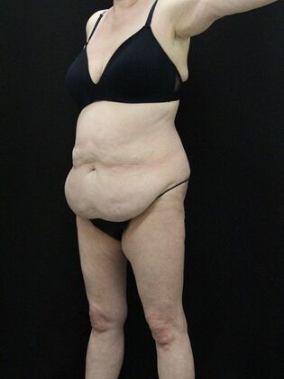 Body Lift: Case 5 - Before
