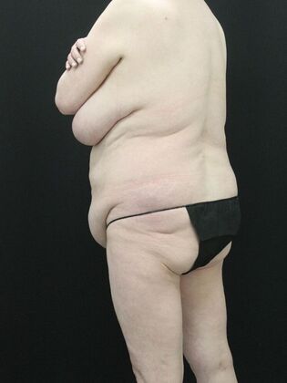 Body Lift: Case 5 - Before