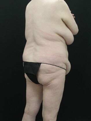 Body Lift: Case 5 - Before
