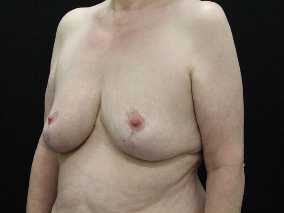 Breast Reduction & Lift: Case 17 - After