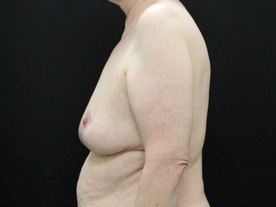 Breast Reduction & Lift: Case 17 - After