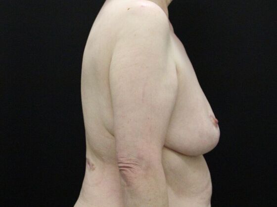 Breast Reduction & Lift: Case 17 - After