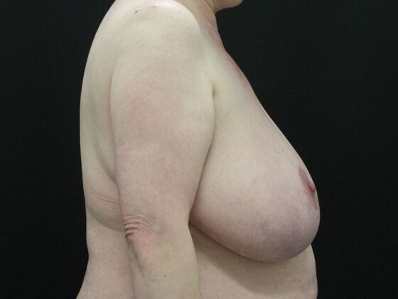 Breast Reduction & Lift: Case 17 - Before