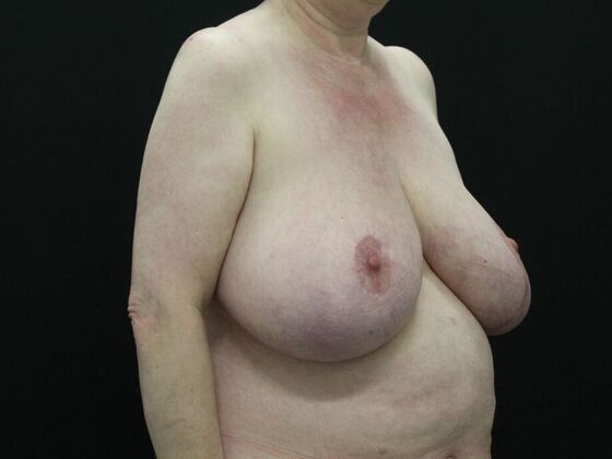Breast Reduction & Lift: Case 17 - Before