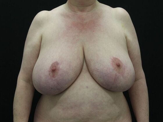 Breast Reduction & Lift Case 17 - Before