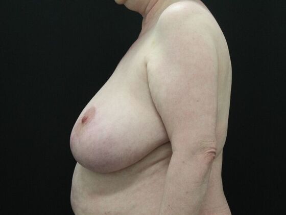 Breast Reduction & Lift: Case 17 - Before