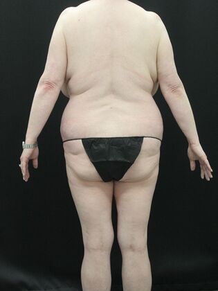 Liposuction Case 35 - Before