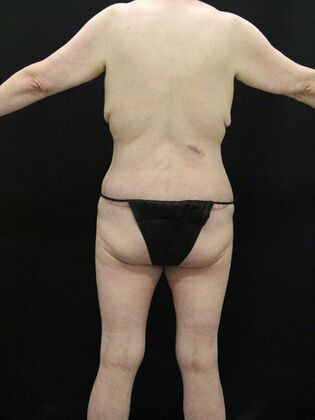 Liposuction Case 35 - After