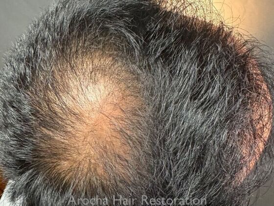 FUE Hair Restoration: Case 36 - After